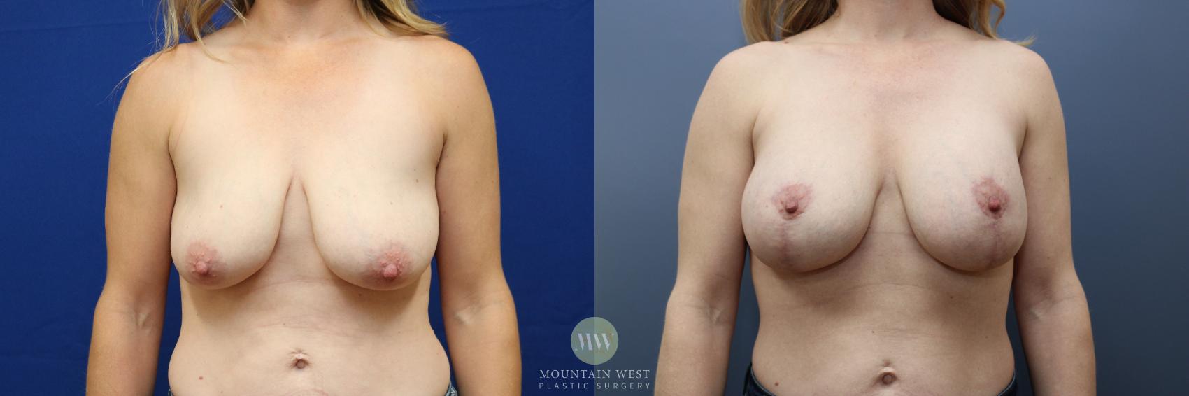 Before & After Breast Lift with Augmentation Case 173 Front View in Kalispell, MT