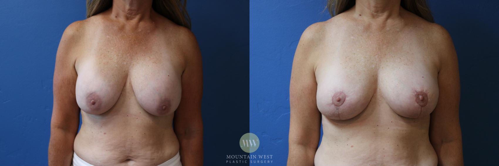 Before & After Breast Lift with Augmentation Case 174 Front View in Kalispell, MT