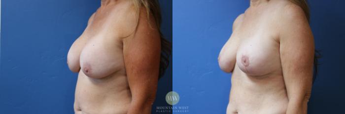 Before & After Breast Lift with Augmentation Case 174 Left Oblique View in Kalispell, MT