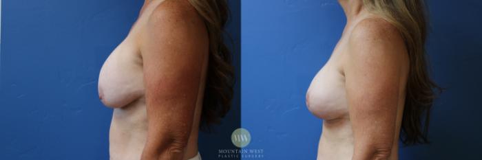 Before & After Breast Lift with Augmentation Case 174 Left Side View in Kalispell, MT