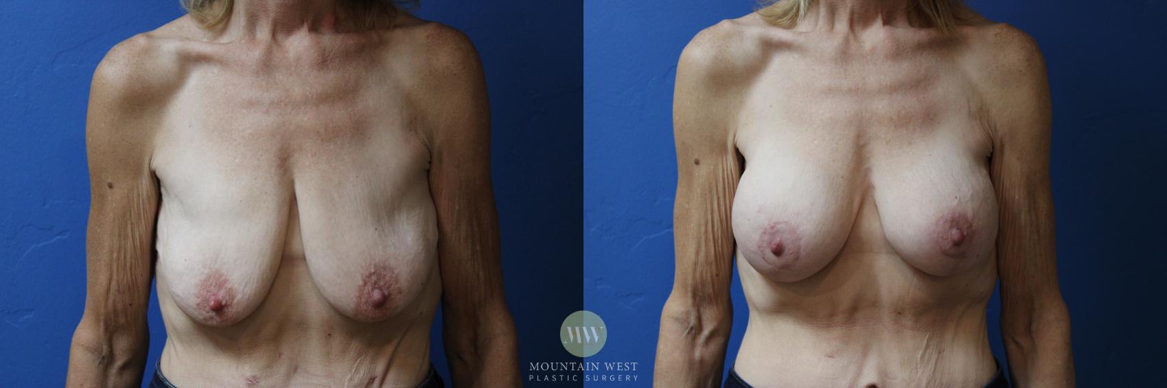 Before & After Breast surgery after weight loss Case 183 Front View in Kalispell, MT