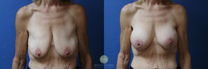 Before & After Breast Lift with Augmentation Case 183 Front View in Kalispell, MT