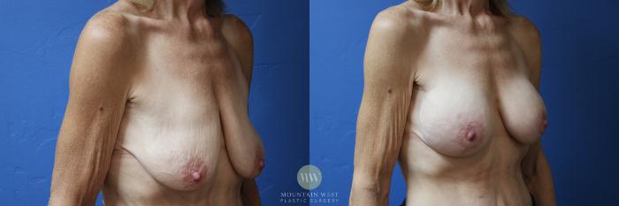 Before & After Breast surgery after weight loss Case 183 Right Oblique View in Kalispell, MT