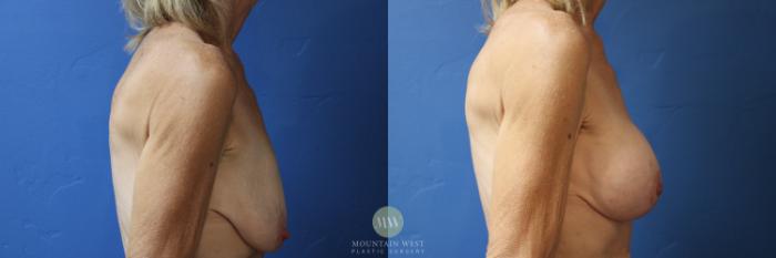 Before & After Breast surgery after weight loss Case 183 Right Side View in Kalispell, MT