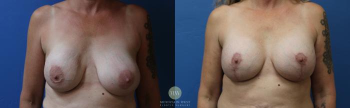 Before & After Breast Augmentation Case 186 Front View in Kalispell, MT