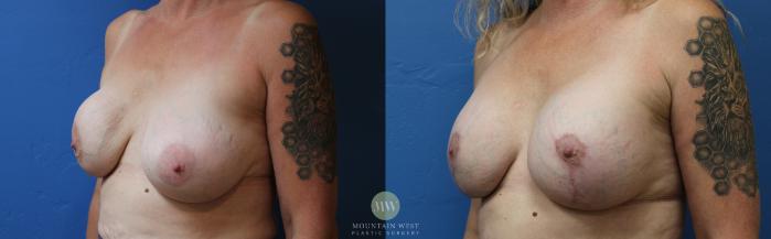 Before & After Breast Augmentation Case 186 Left Oblique View in Kalispell, MT