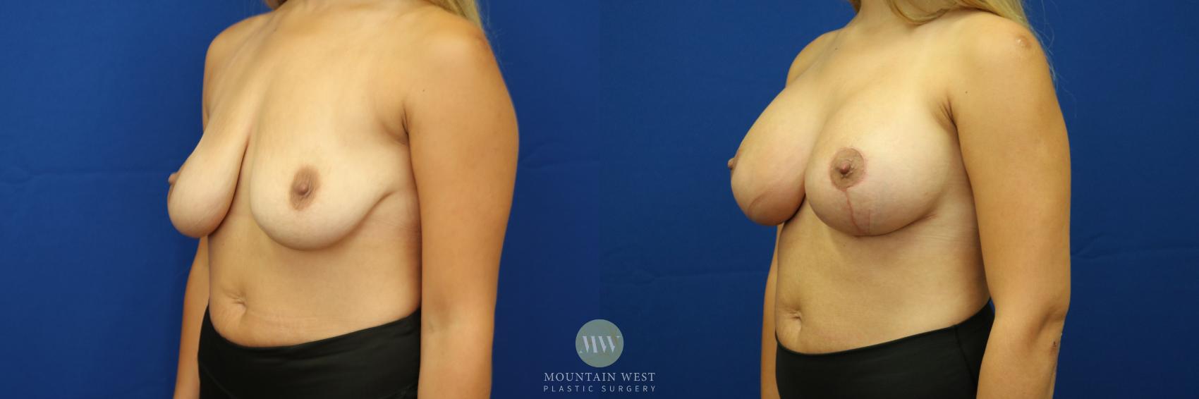 Breast Lift with Augmentation Case 45 Before & After View #1 | Kalispell, MT | Mountain West Plastic Surgery