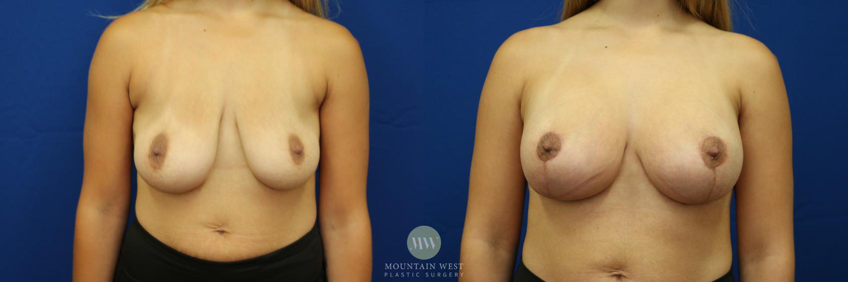 Before & After Breast Lift with Augmentation Case 46 View #1 View in Kalispell, MT