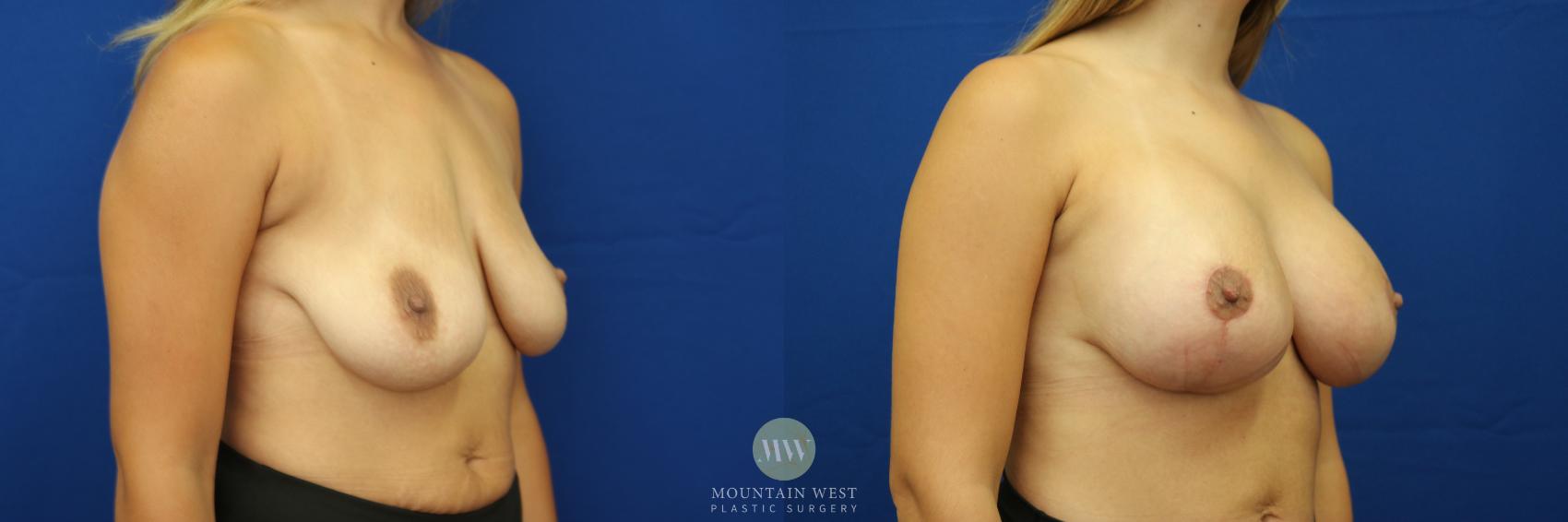 Breast Lift with Augmentation Case 46 Before & After View #2 | Kalispell, MT | Mountain West Plastic Surgery