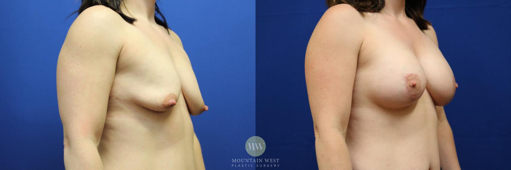 Breast Lift with Augmentation Case 95 Before & After Right Oblique | Kalispell, MT | Mountain West Plastic Surgery