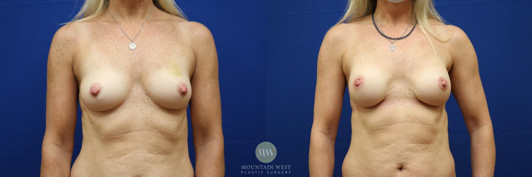 Breast Reconstruction Case 124 Before & After Front | Kalispell, MT | Mountain West Plastic Surgery