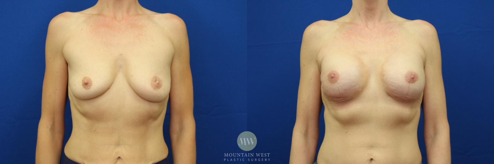 Breast Reconstruction Case 35 Before & After View #1 | Kalispell, MT | Mountain West Plastic Surgery