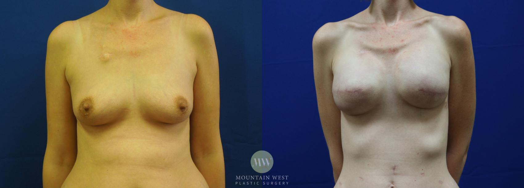 Breast Reconstruction Case 48 Before & After View #1 | Kalispell, MT | Mountain West Plastic Surgery