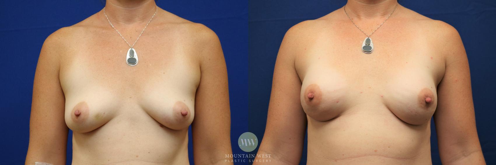 Breast Reconstruction Case 96 Before & After Front | Kalispell, MT | Mountain West Plastic Surgery
