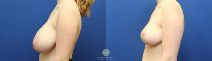 Before & After Breast Reduction Case 118 Left Side View in Kalispell, MT