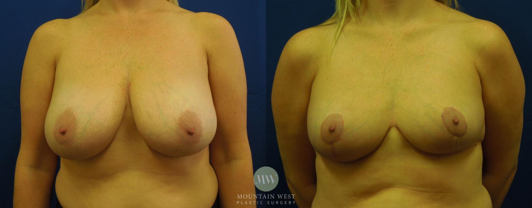 Before & After Breast Reduction Case 13 View #1 View in Kalispell, MT
