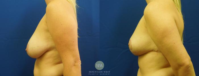 Before & After Breast Reduction Case 13 View #2 View in Kalispell, MT