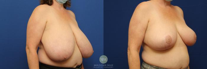 Before & After Breast Reduction Case 141 Right Oblique View in Kalispell, MT
