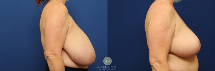 Before & After Breast Reduction Case 141 Right Side View in Kalispell, MT