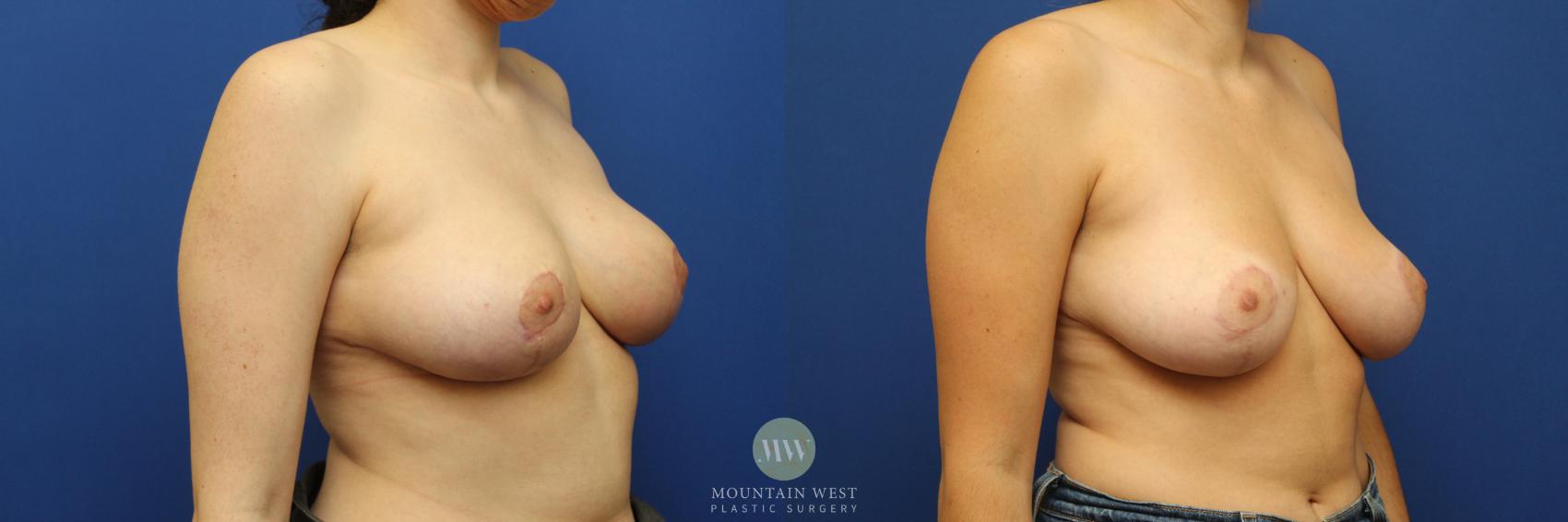 Breast Reduction, 3 and 6 months postop