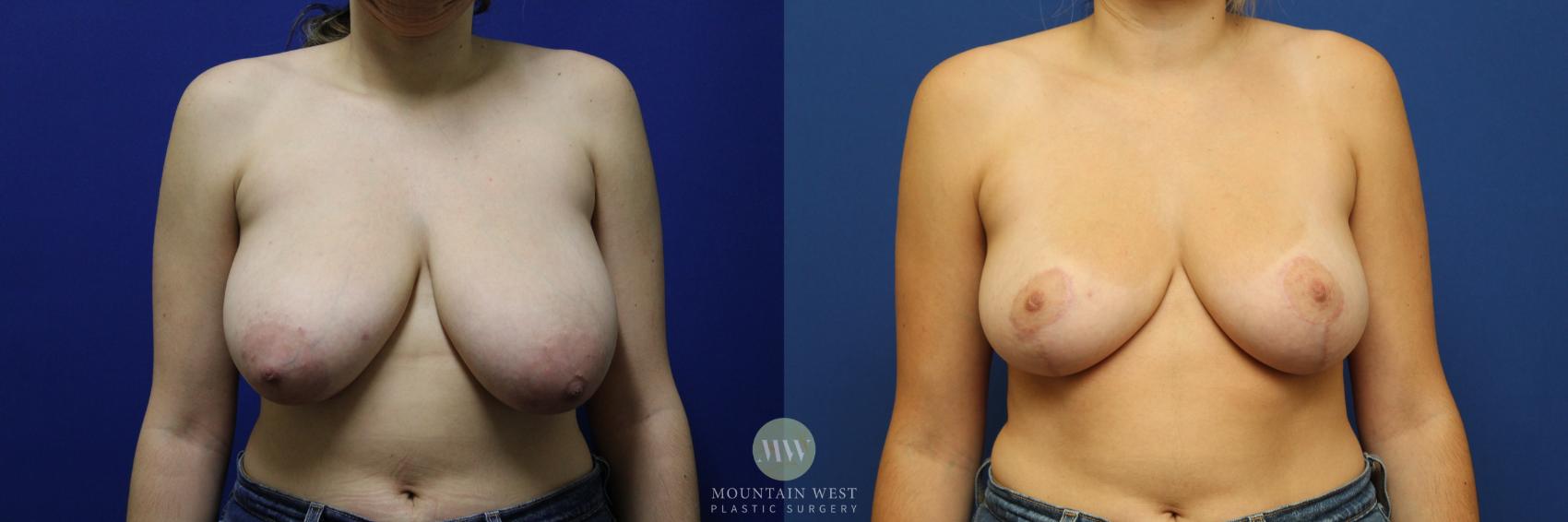 Breast Reduction, Before and 6 Months Postop, 1 pound reduction each side 