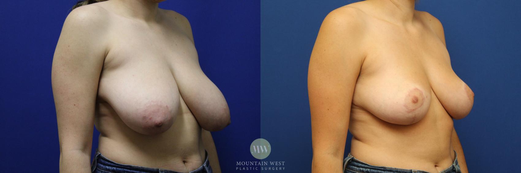 Breast Reduction Case 142 Before & After Right Oblique | Kalispell, MT | Mountain West Plastic Surgery