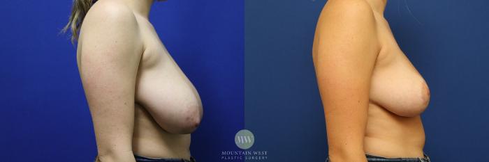 Breast Reduction, Before and 6 Months Postop