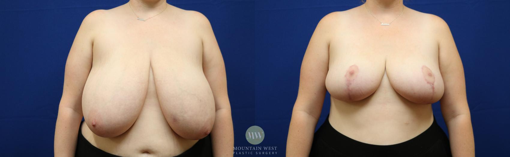 Breast Reduction Case 146 Before & After Front | Kalispell, MT | Mountain West Plastic Surgery