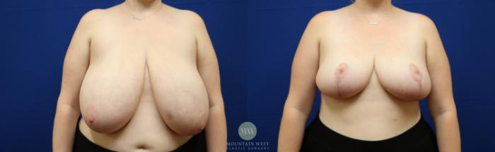 Before & After Breast Reduction Case 146 Front View in Kalispell, MT