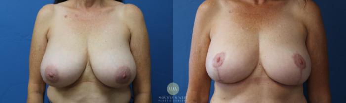 Before & After Breast Reduction Case 157 Front View in Kalispell, MT