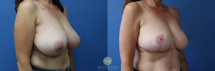 Before & After Breast Reduction Case 157 Right Oblique View in Kalispell, MT