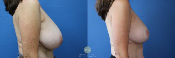 Before & After Breast Reduction Case 157 Right Side View in Kalispell, MT