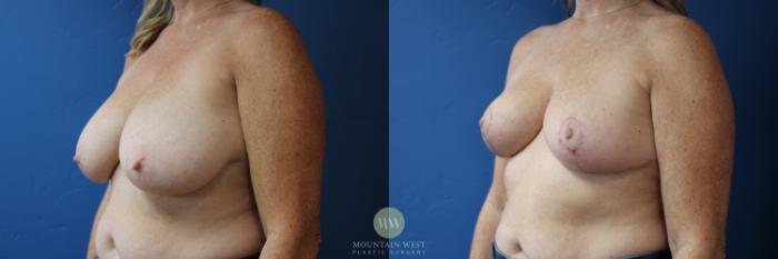 Before & After Breast Reduction Case 166 Left Oblique View in Kalispell, MT