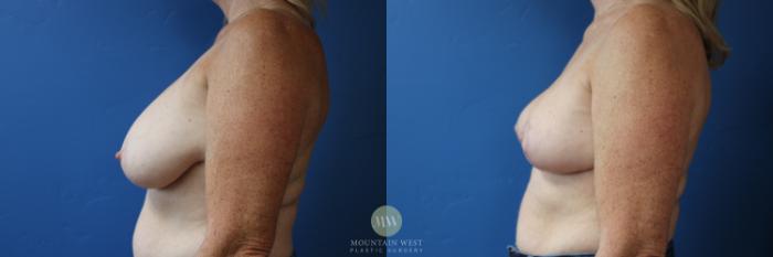 Before & After Breast Reduction Case 166 Left Side View in Kalispell, MT