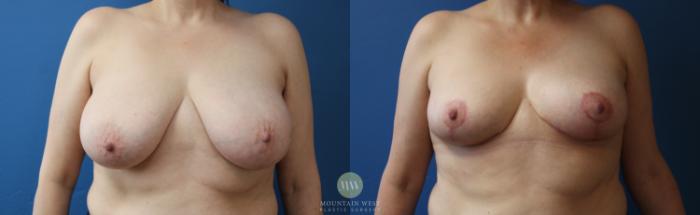 Before & After Breast Reduction Case 170 Front View in Kalispell, MT