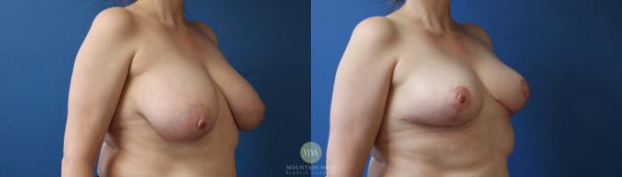 Before & After Breast Reduction Case 170 Right Oblique View in Kalispell, MT