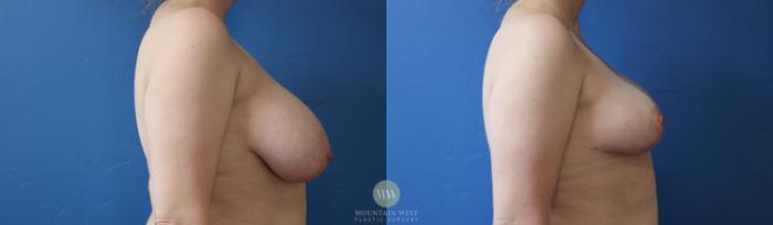 Before & After Breast Reduction Case 170 Right Side View in Kalispell, MT