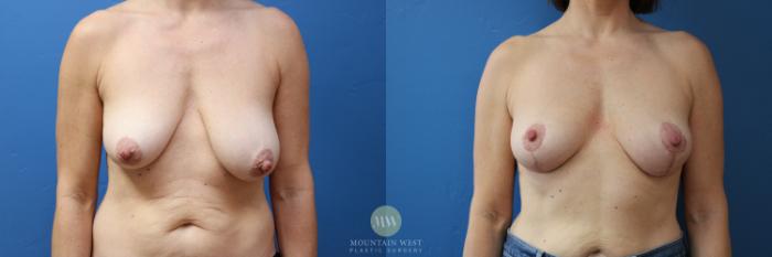 Before & After Breast Lift Case 177 Front View in Kalispell, MT