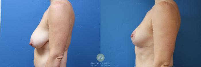 Before & After Breast Lift Case 177 Left Side View in Kalispell, MT