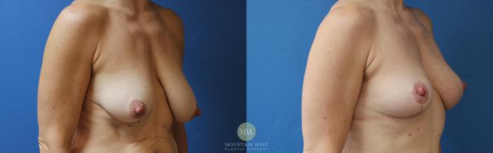 Before & After Breast Lift Case 177 Right Oblique View in Kalispell, MT