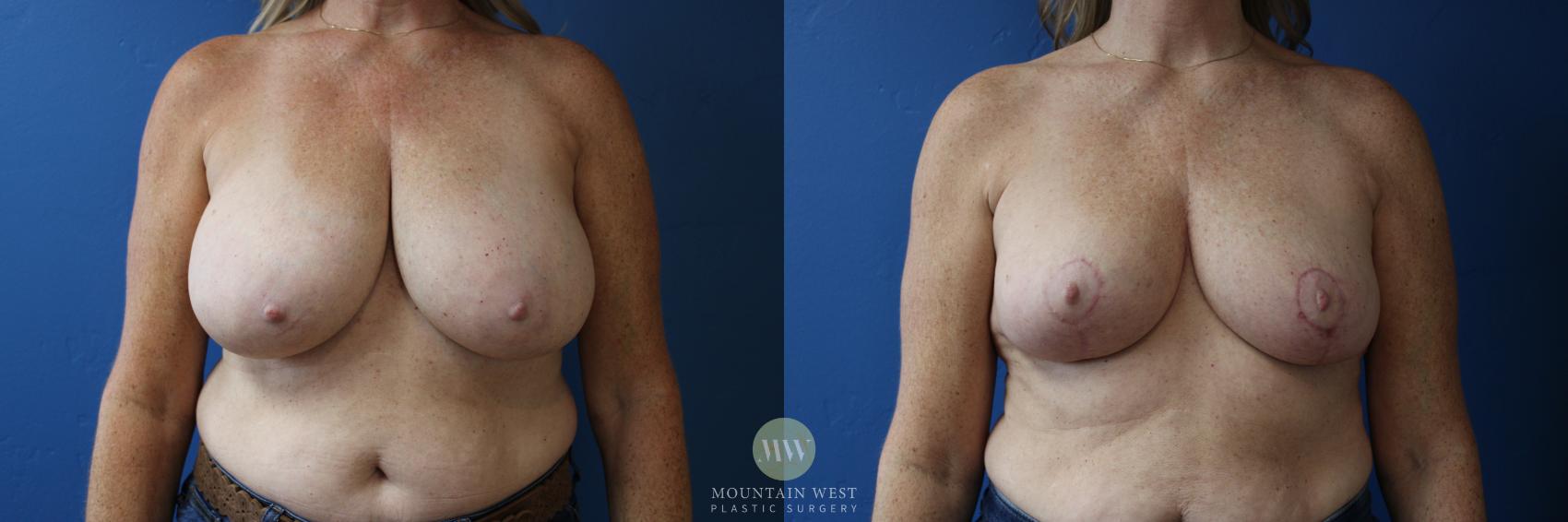 Before & After Breast Reduction Case 178 Front View in Kalispell, MT