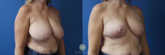 Before & After Breast Reduction Case 178 Right Oblique View in Kalispell, MT