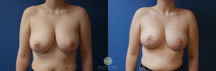 Before & After Breast Reduction Case 179 Front View in Kalispell, MT