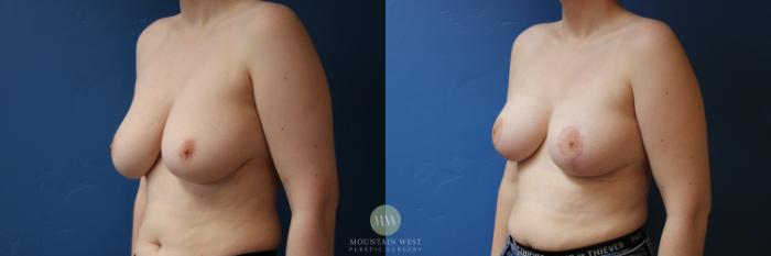 Before & After Breast Reduction Case 179 Left Oblique View in Kalispell, MT