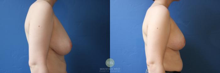 Before & After Breast Reduction Case 179 Right Side View in Kalispell, MT