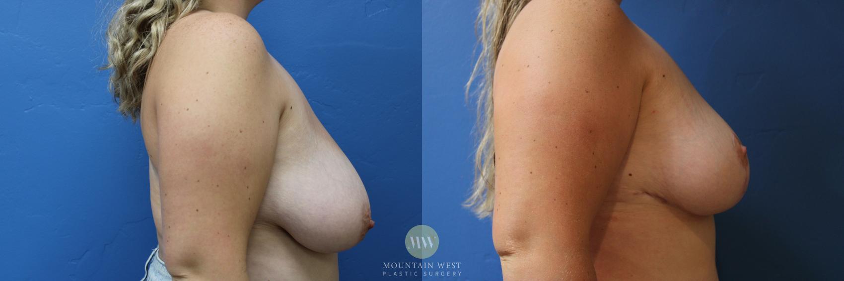 Before & After Breast Reduction Case 185 Right Side View in Kalispell, MT