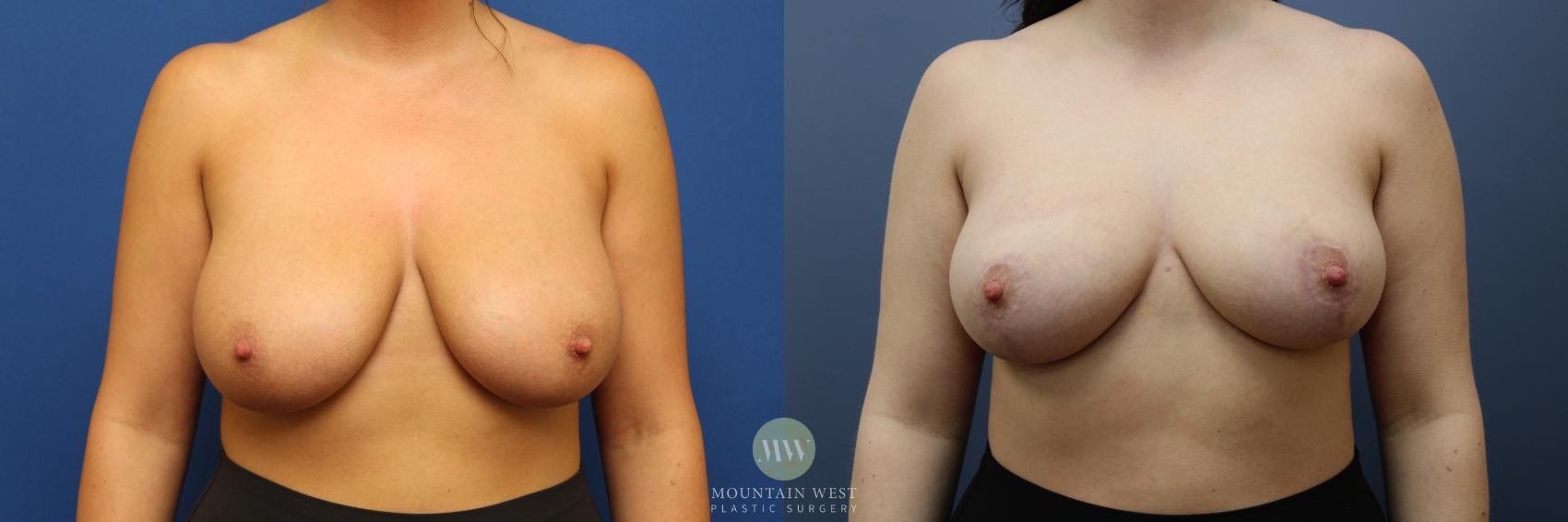 Before & After Breast Reduction Case 189 Front View in Kalispell, MT