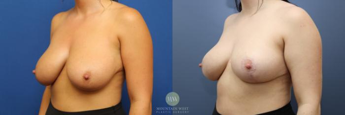 Before & After Breast Reduction Case 189 Left Oblique View in Kalispell, MT