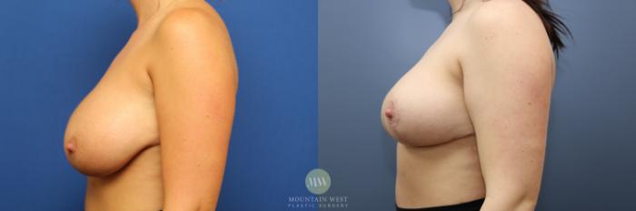 Before & After Breast Reduction Case 189 Left Side View in Kalispell, MT