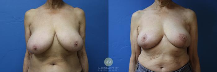 Before & After Breast Reduction Case 191 Front View in Kalispell, MT